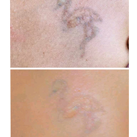 Tattoo Removal